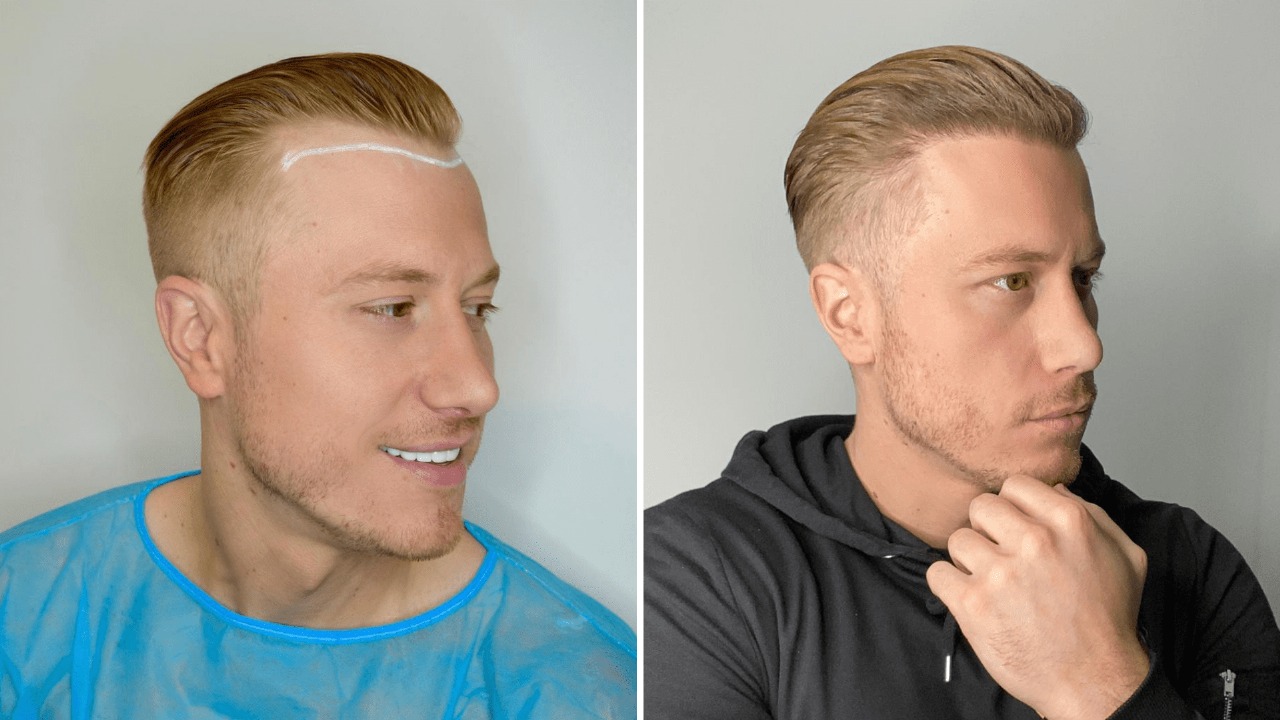 Hair Transplant UK Surgeons with Over 10 Years of Experience